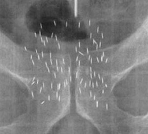 БРАХИТЕРАПИЯ - рентгенограмма области простаты - видны зерна, содержащие йод-125, фиксированные на нити